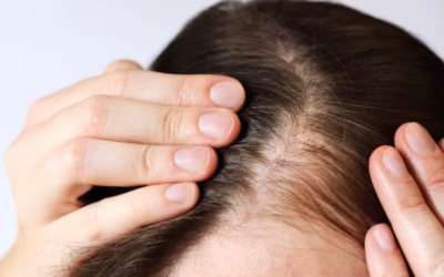 บทความเกี่ยวกับผมร่วง